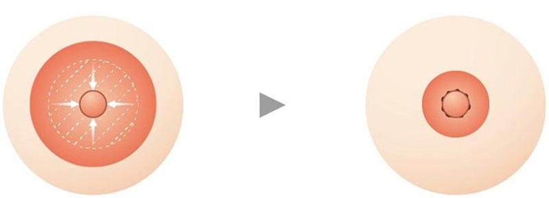 Ưu điểm của công nghệ thu nhỏ quầng vú