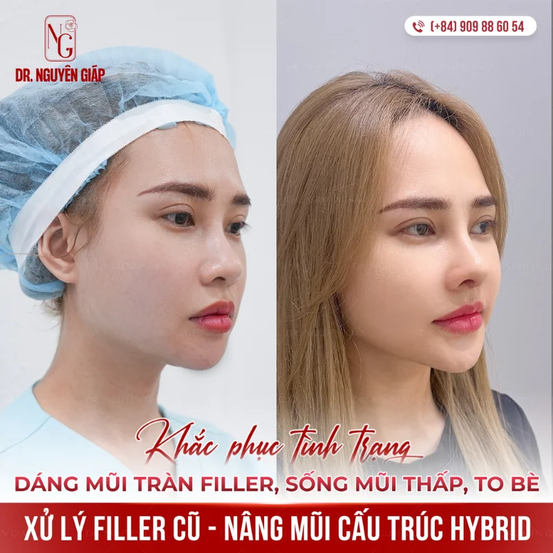 khac phuc mui lech bang phuong phap nang mui cau truc bybrid (1) Chỉnh sửa dáng mũi lệch vẹo bằng kỹ thuật nâng mũi cấu trúc Hybrid an toàn.