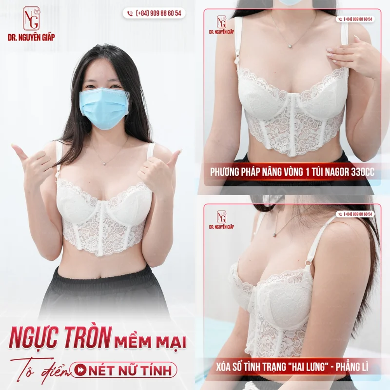review khach hang nang nguc review khách hàng hút mỡ nâng ngực