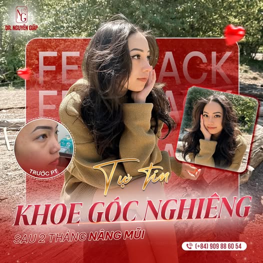 khach hang nang mui khách hàng nâng mũi tại bác sĩ Nguyên Giáp